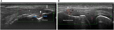 High Prevalence of Ultrasound Verified Enthesitis in Patients With Inflammatory Bowel Disease With or Without Spondylarthritis